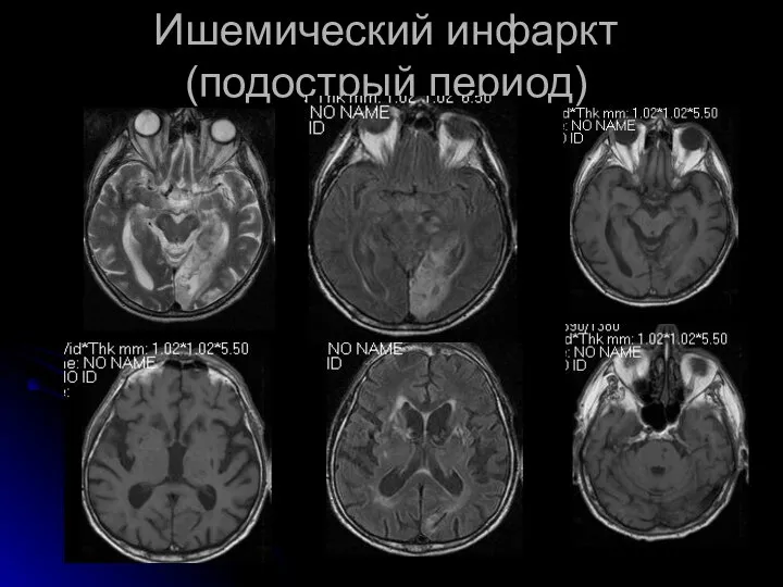 Ишемический инфаркт (подострый период)