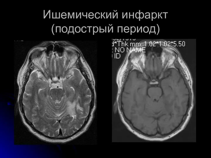 Ишемический инфаркт (подострый период)