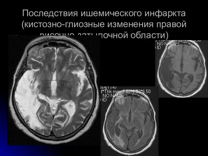 Последствия ишемического инфаркта (кистозно-глиозные изменения правой височно-затылочной области)