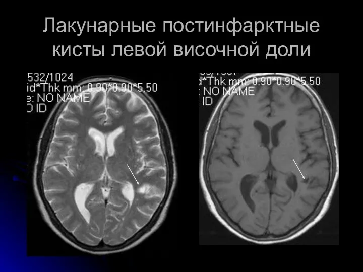 Лакунарные постинфарктные кисты левой височной доли