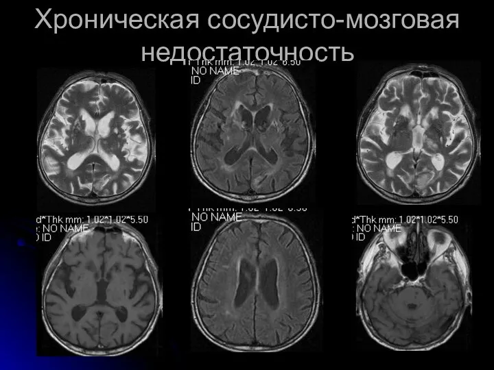 Хроническая сосудисто-мозговая недостаточность