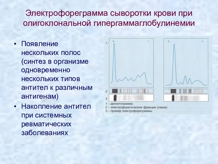 Электрофореграмма сыворотки крови при олигоклональной гипергаммаглобулинемии Появление нескольких полос (синтез в