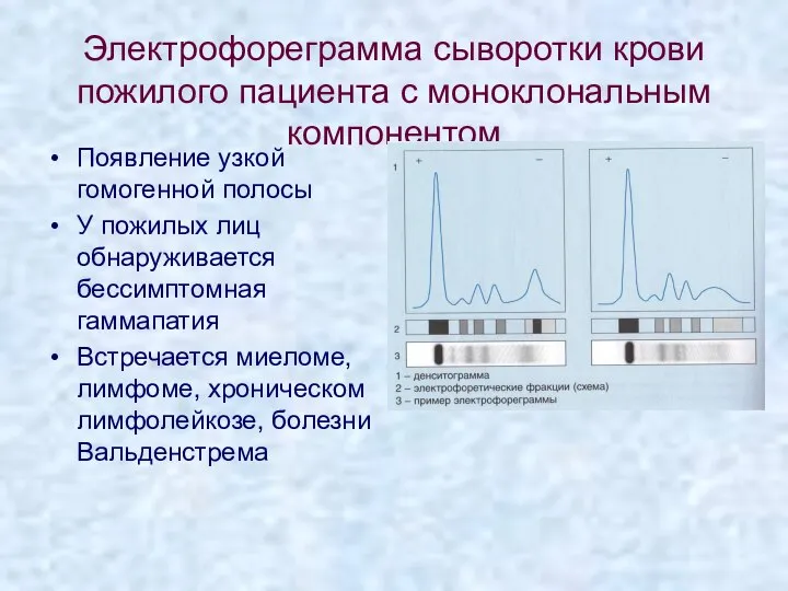 Электрофореграмма сыворотки крови пожилого пациента с моноклональным компонентом Появление узкой гомогенной