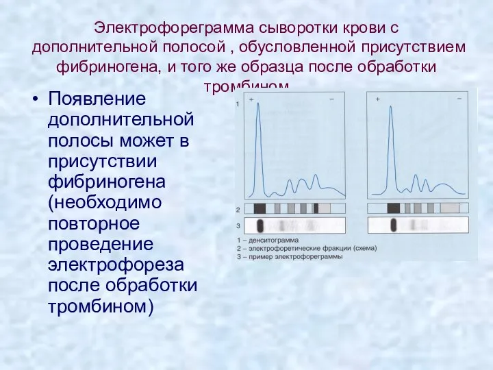 Электрофореграмма сыворотки крови с дополнительной полосой , обусловленной присутствием фибриногена, и