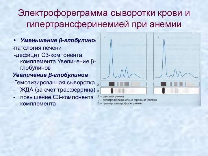 Электрофореграмма сыворотки крови и гипертрансферинемией при анемии Уменьшение β-глобулинов -патология печени