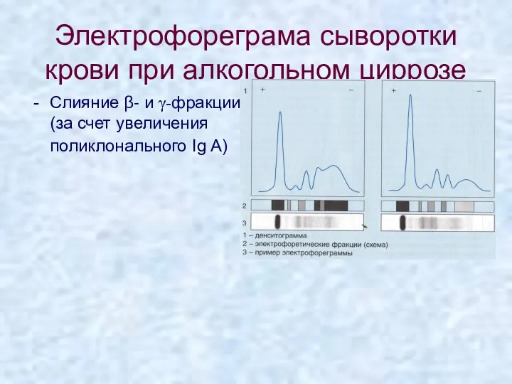 Электрофореграма сыворотки крови при алкогольном циррозе Слияние β- и γ-фракции (за счет увеличения поликлонального Ig A)