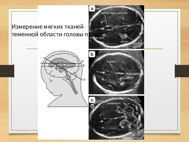 Измерение мягких тканей теменной области головы плода