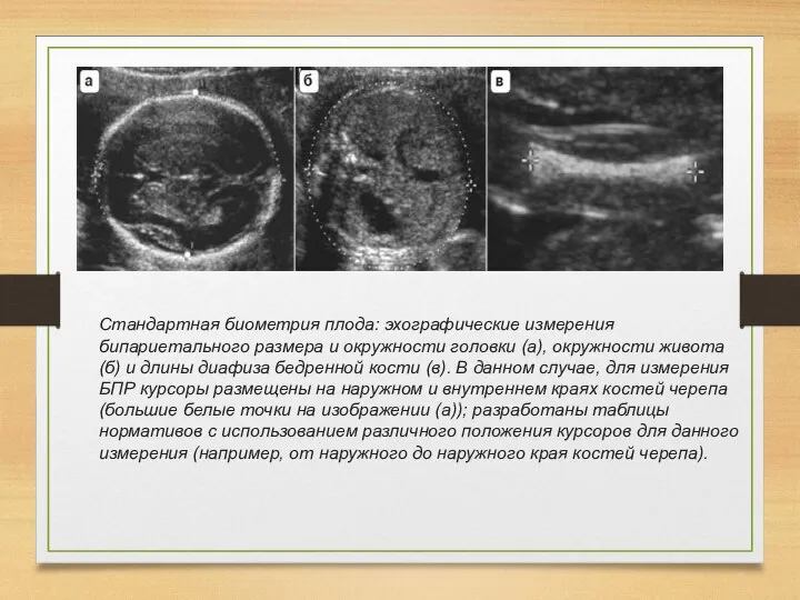 Стандартная биометрия плода: эхографические измерения бипариетального размера и окружности головки (а),