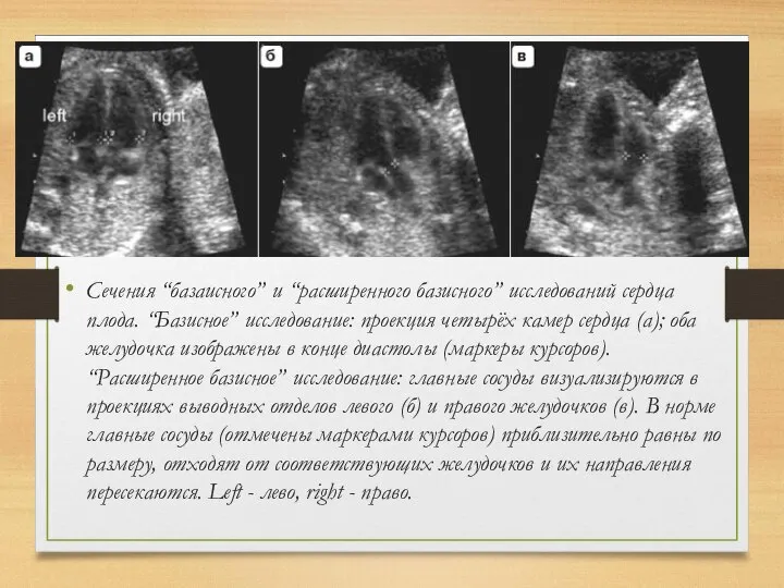 Сечения “базаисного” и “расширенного базисного” исследований сердца плода. “Базисное” исследование: проекция