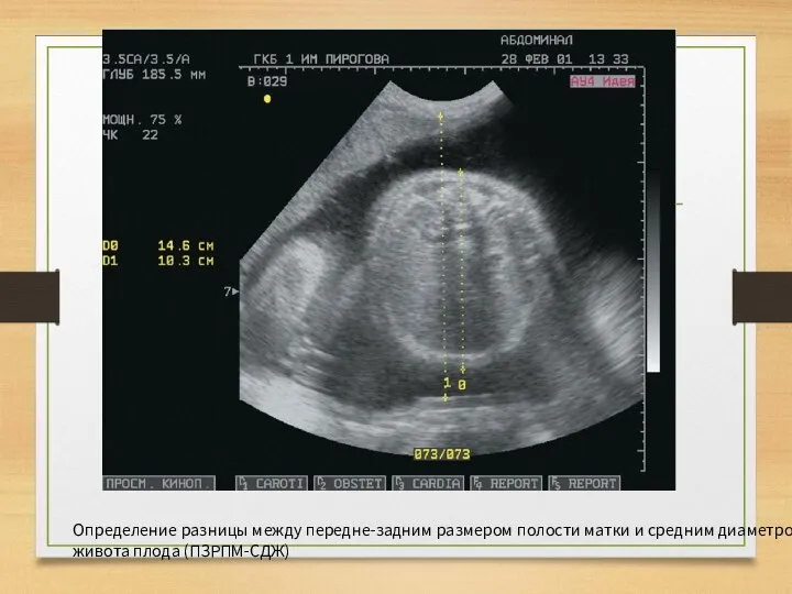 Определение разницы между передне-задним размером полости матки и средним диаметром живота плода (ПЗРПМ-СДЖ)