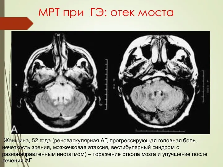 МРТ при ГЭ: отек моста Женщина, 52 года (реноваскулярная АГ, прогрессирующая