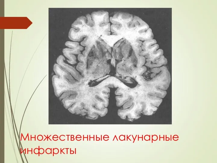 Множественные лакунарные инфаркты