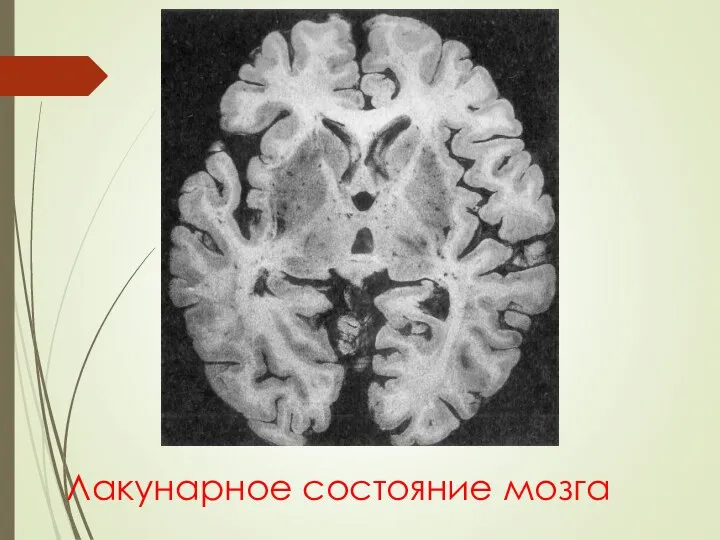 Лакунарное состояние мозга