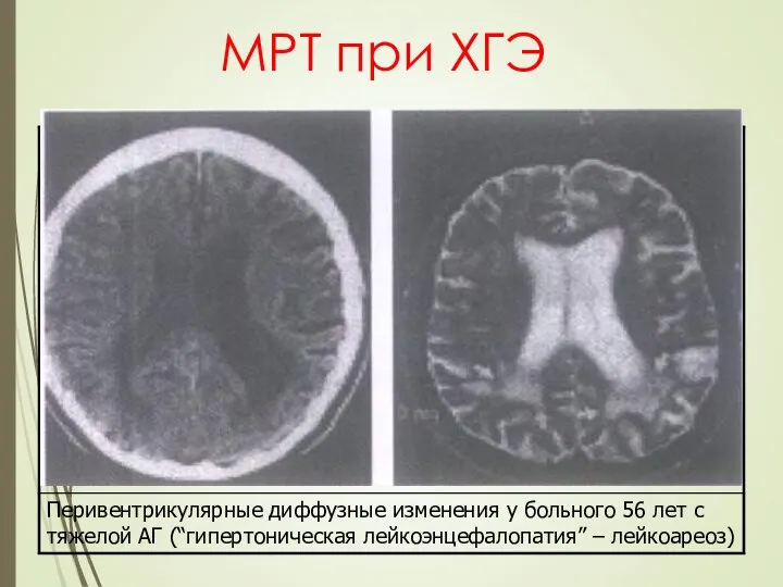 МРТ при ХГЭ