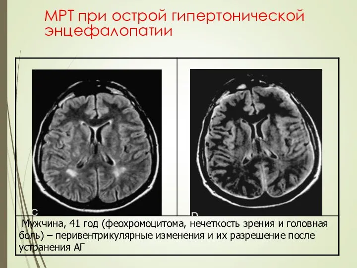 МРТ при острой гипертонической энцефалопатии