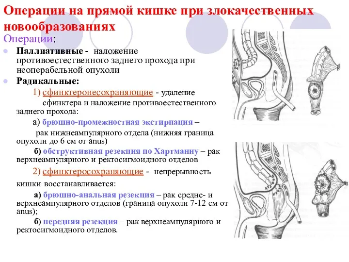 Операции на прямой кишке при злокачественных новообразованиях Операции: Паллиативные - наложение