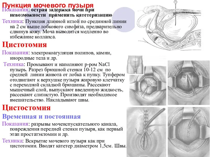 Пункция мочевого пузыря Показания: острая задержка мочи при невозможности применить катетеризацию