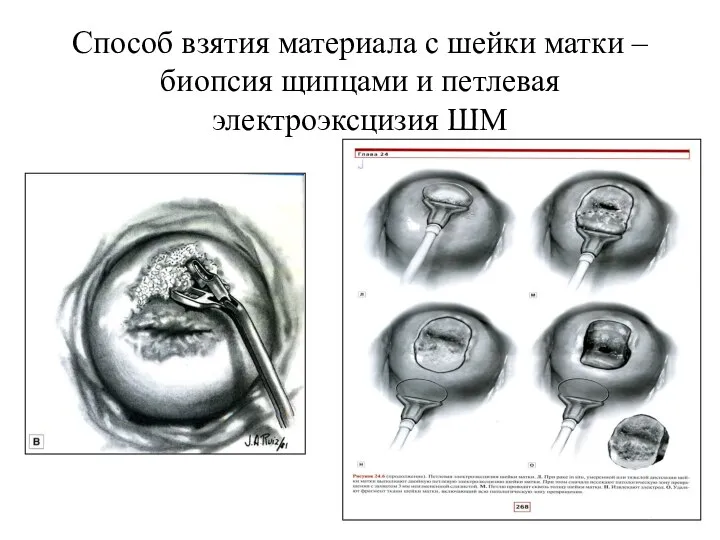 Способ взятия материала с шейки матки – биопсия щипцами и петлевая электроэксцизия ШМ