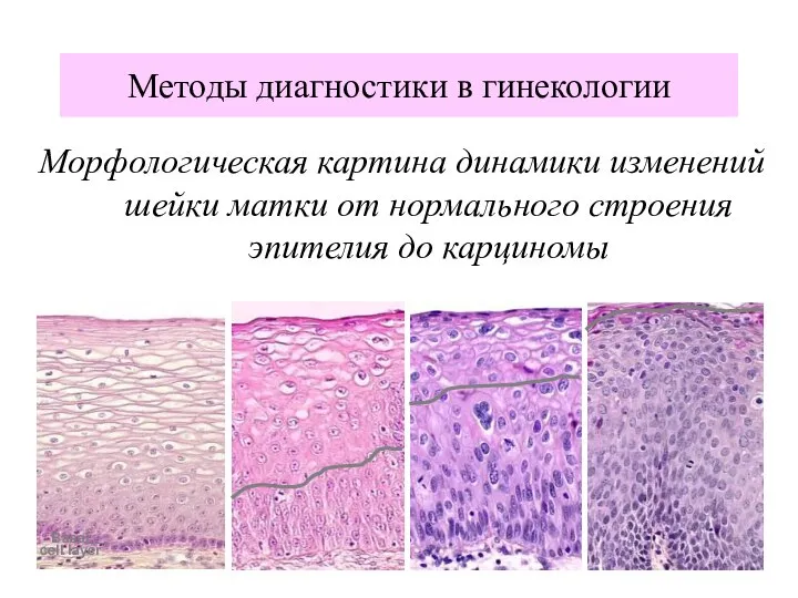 Морфологическая картина динамики изменений шейки матки от нормального строения эпителия до карциномы Методы диагностики в гинекологии