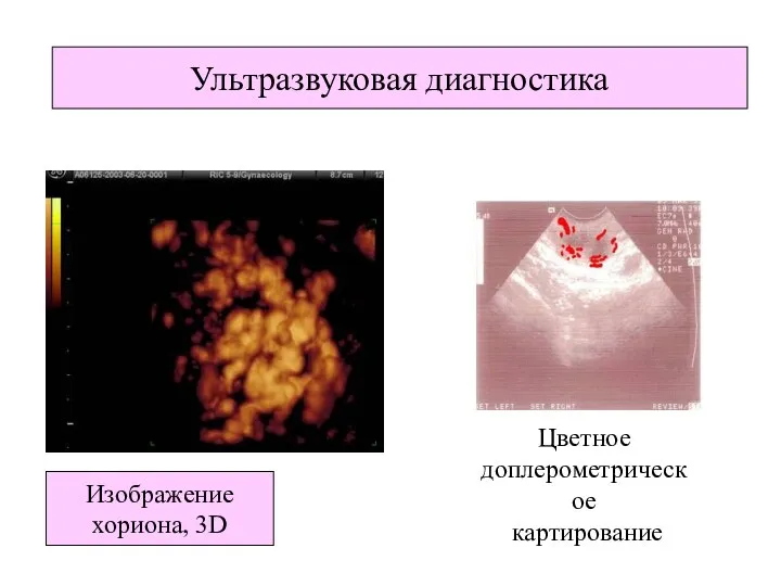 Изображение хориона, 3D Ультразвуковая диагностика Цветное доплерометрическое картирование