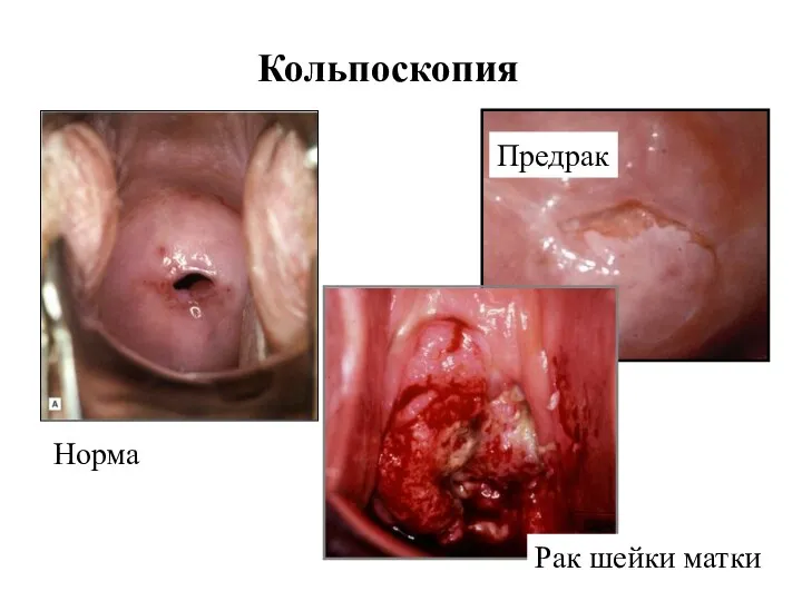 Кольпоскопия Норма Рак шейки матки Предрак