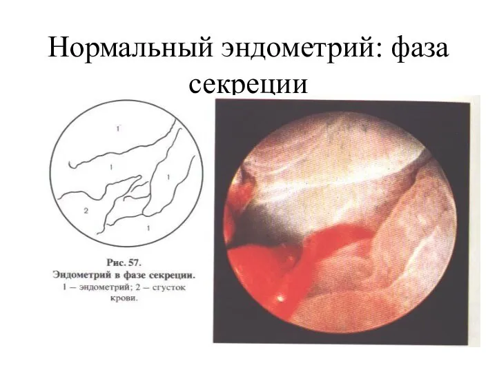 Нормальный эндометрий: фаза секреции