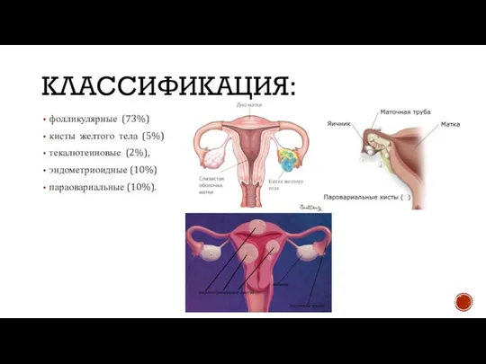 КЛАССИФИКАЦИЯ: фолликулярные (73%) кисты желтого тела (5%) текалютеиновые (2%), эндометриоидные (10%) параовариальные (10%).