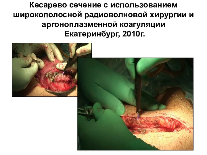 Кесарево сечение с использованием широкополосной радиоволновой хирургии и аргоноплазменной коагуляции Екатеринбург, 2010г.