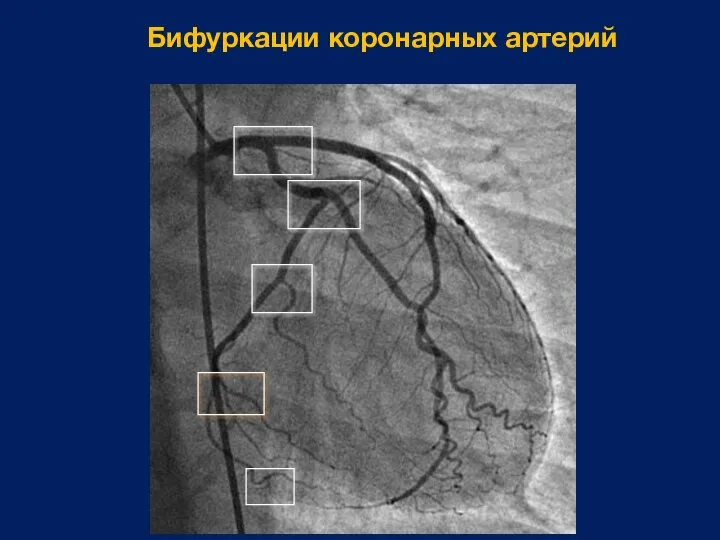 Бифуркации коронарных артерий