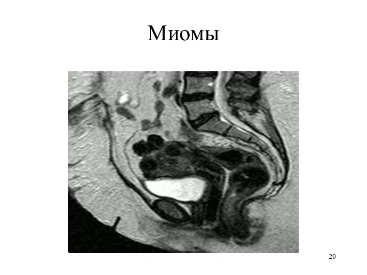 Миомы