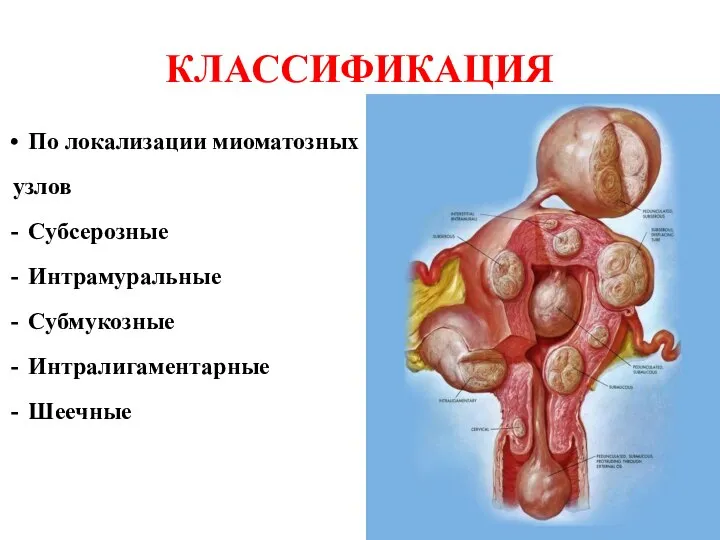 КЛАССИФИКАЦИЯ По локализации миоматозных узлов Субсерозные Интрамуральные Субмукозные Интралигаментарные Шеечные