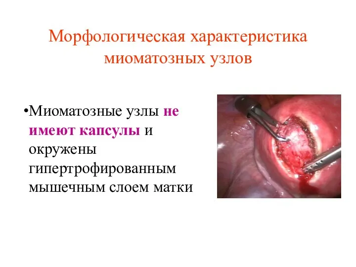 Морфологическая характеристика миоматозных узлов Миоматозные узлы не имеют капсулы и окружены гипертрофированным мышечным слоем матки