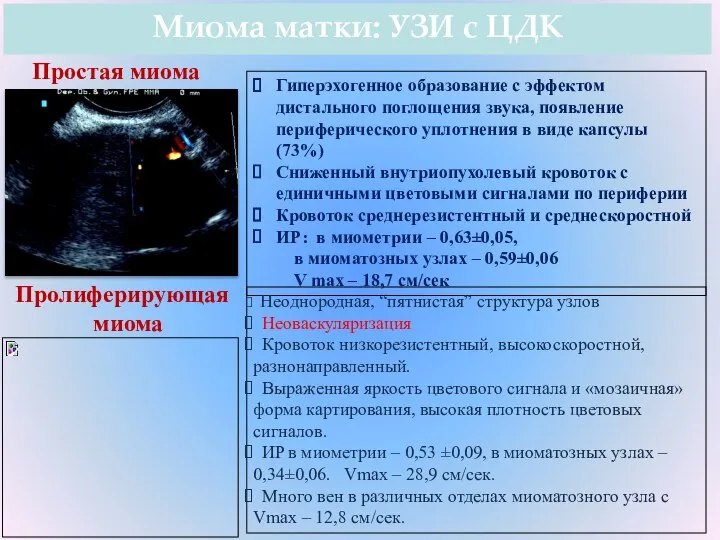 Миома матки: УЗИ с ЦДК Гиперэхогенное образование с эффектом дистального поглощения