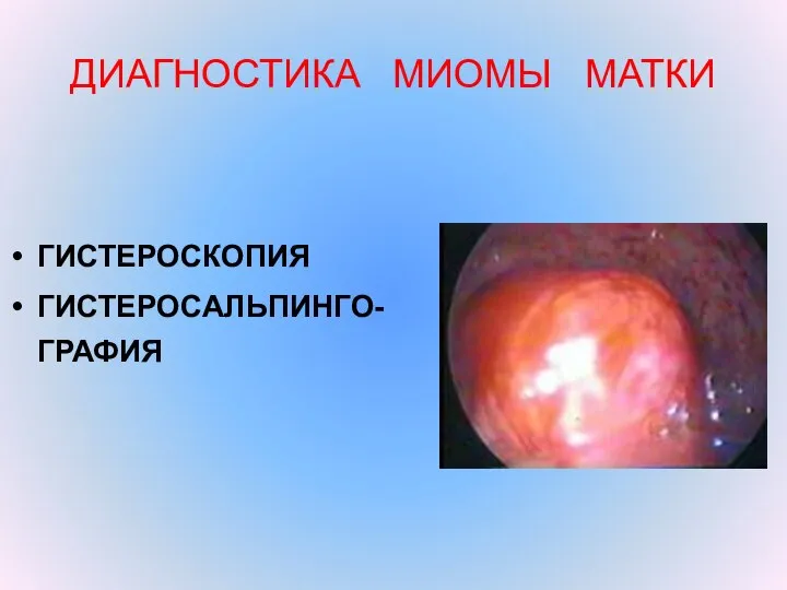 ДИАГНОСТИКА МИОМЫ МАТКИ ГИСТЕРОСКОПИЯ ГИСТЕРОСАЛЬПИНГО-ГРАФИЯ