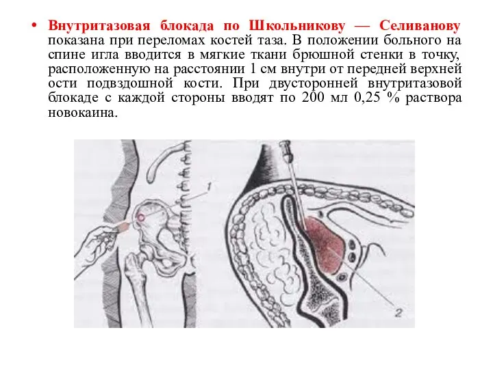 Внутритазовая блокада по Школьникову — Селиванову показана при переломах костей таза.