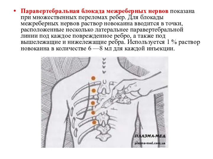 Паравертебральная блокада межреберных нервов показана при множественных переломах ребер. Для блокады