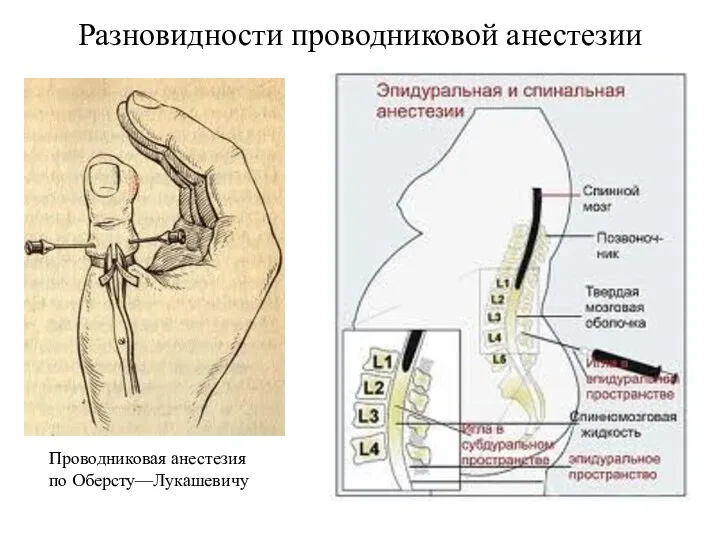 Проводниковая анестезия по Оберсту—Лукашевичу Разновидности проводниковой анестезии