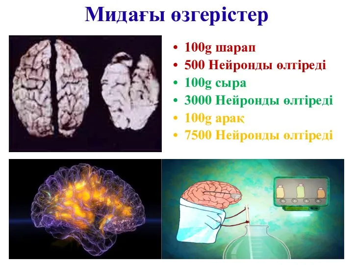 Мидағы өзгерістер 100g шарап 500 Нейронды өлтіреді 100g сыра 3000 Нейронды