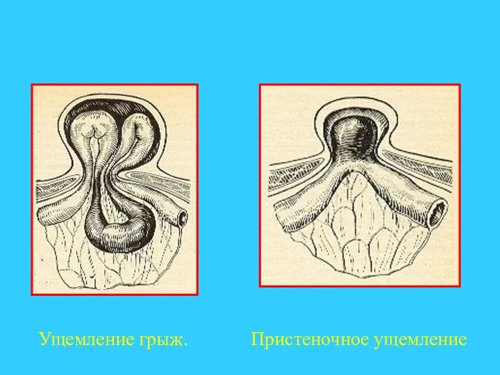 Ущемление грыж. Пристеночное ущемление