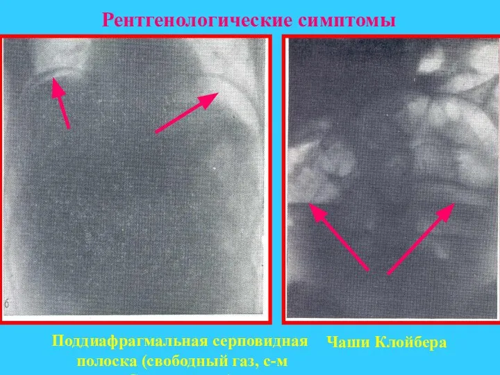 Рентгенологические симптомы Поддиафрагмальная серповидная полоска (свободный газ, с-м Спижарского)‏ Чаши Клойбера