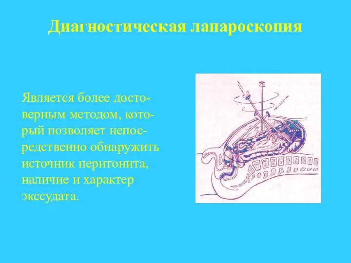 Диагностическая лапароскопия Является более досто-верным методом, кото-рый позволяет непос-редственно обнаружить источник перитонита, наличие и характер экссудата.