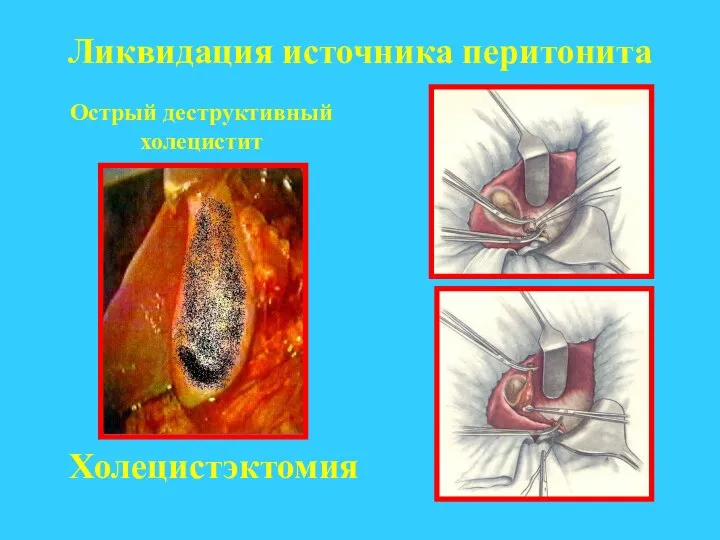 Ликвидация источника перитонита Острый деструктивный холецистит Холецистэктомия