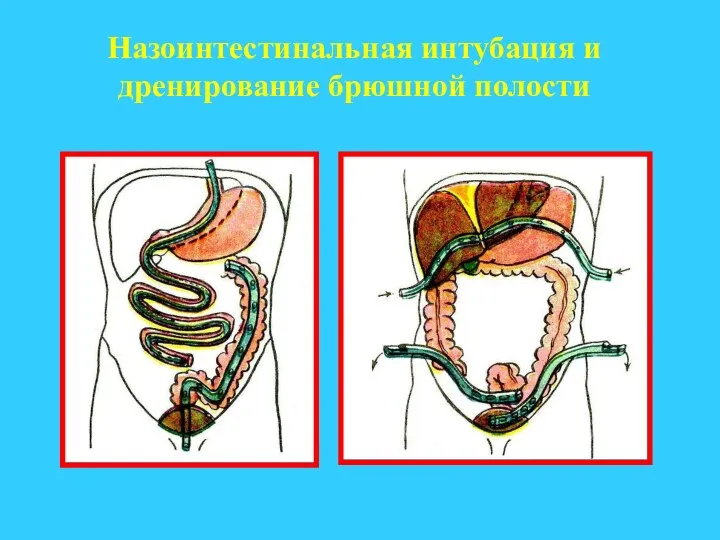 Назоинтестинальная интубация и дренирование брюшной полости