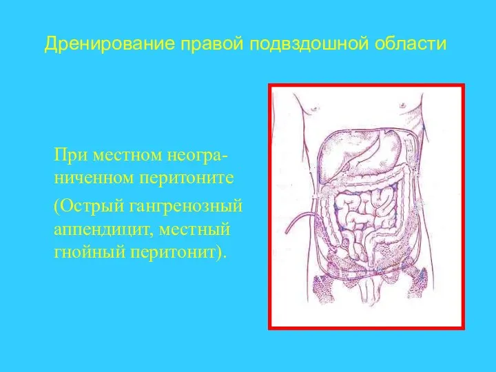 При местном неогра-ниченном перитоните (Острый гангренозный аппендицит, местный гнойный перитонит). Дренирование правой подвздошной области