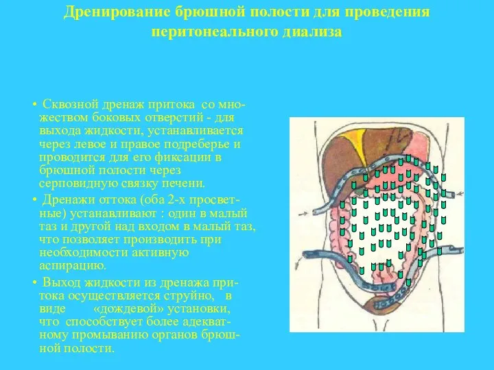 Дренирование брюшной полости для проведения перитонеального диализа Сквозной дренаж притока со