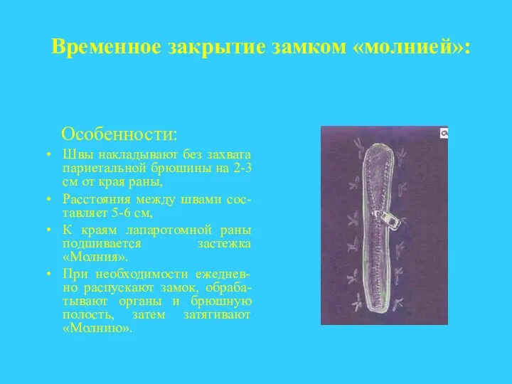 Временное закрытие замком «молнией»: Особенности: Швы накладывают без захвата париетальной брюшины