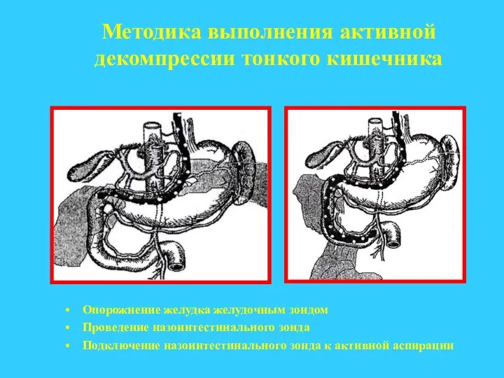 Методика выполнения активной декомпрессии тонкого кишечника Опорожнение желудка желудочным зондом Проведение