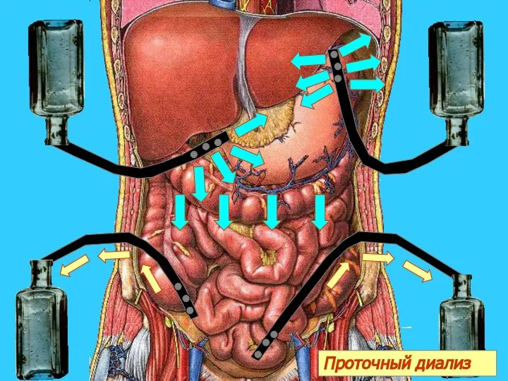 я Проточный диализ