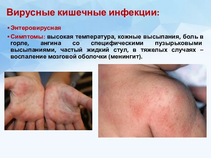 Вирусные кишечные инфекции: Энтеровирусная Симптомы: высокая температура, кожные высыпания, боль в