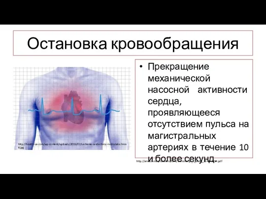 Остановка кровообращения Прекращение механической насосной активности сердца, проявляющееся отсутствием пульса на